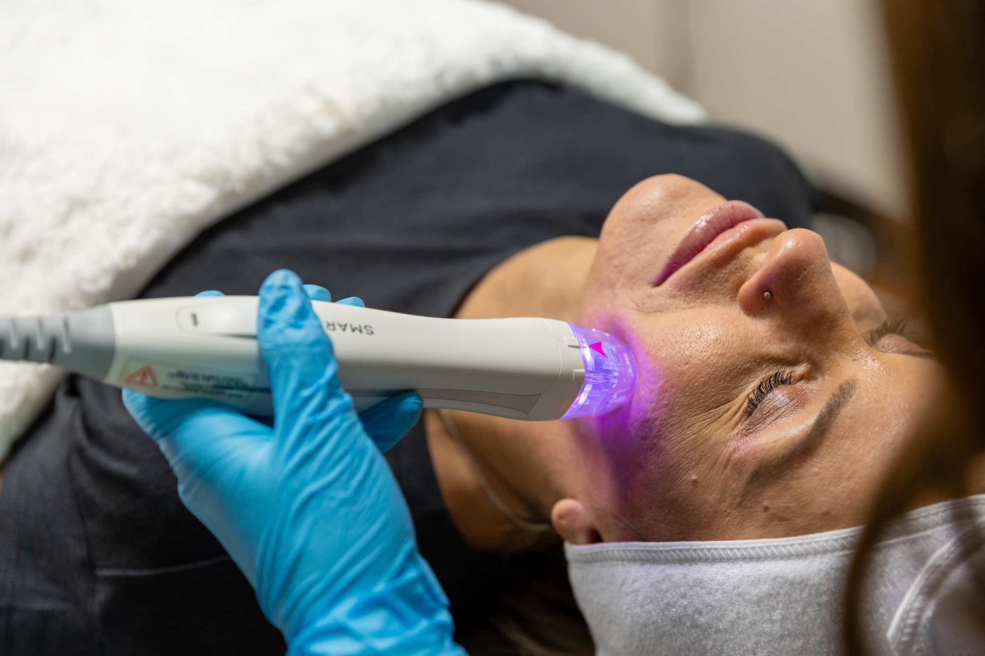 Medical professional uses SmartPen on patient for facial rejuvenation in Leawood