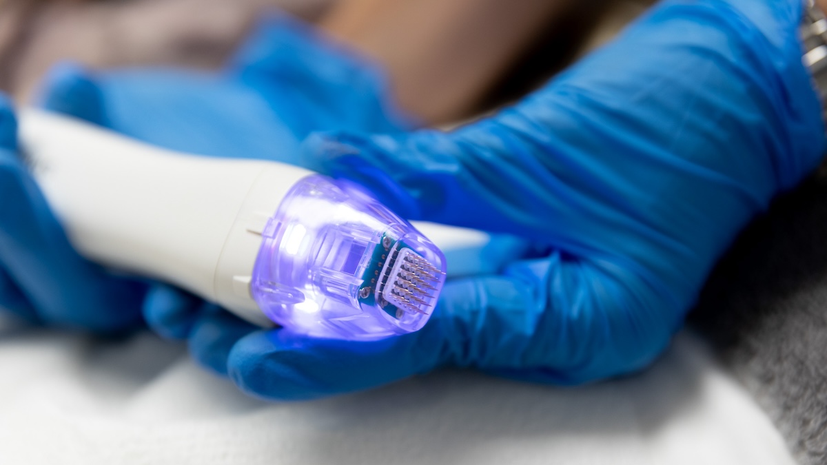 Close up shot of handheld device used during treatment for microneedling for stretch marks in Leawood.
