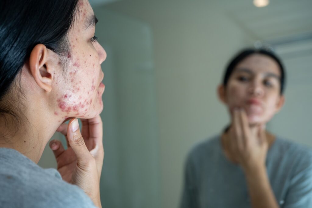 woman assesses need for acne treatment in Kansas City