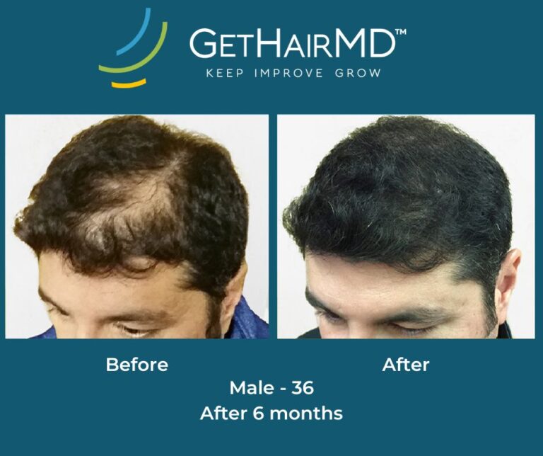 Male Pattern Baldness Treatment in Kansas City Regain