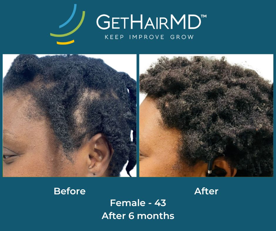 Before and after photos of hair restoration, the before photo shows thinning hair and a visible scalp, while the after photo shows the affects of DHT blocker in Lawrence with significantly more hair and less scalp