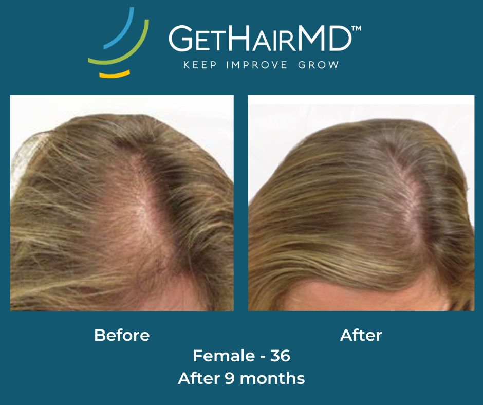 Before and after photo of woman's scalp with significantly more hair thanks to the program for hair restoration near Overland Park