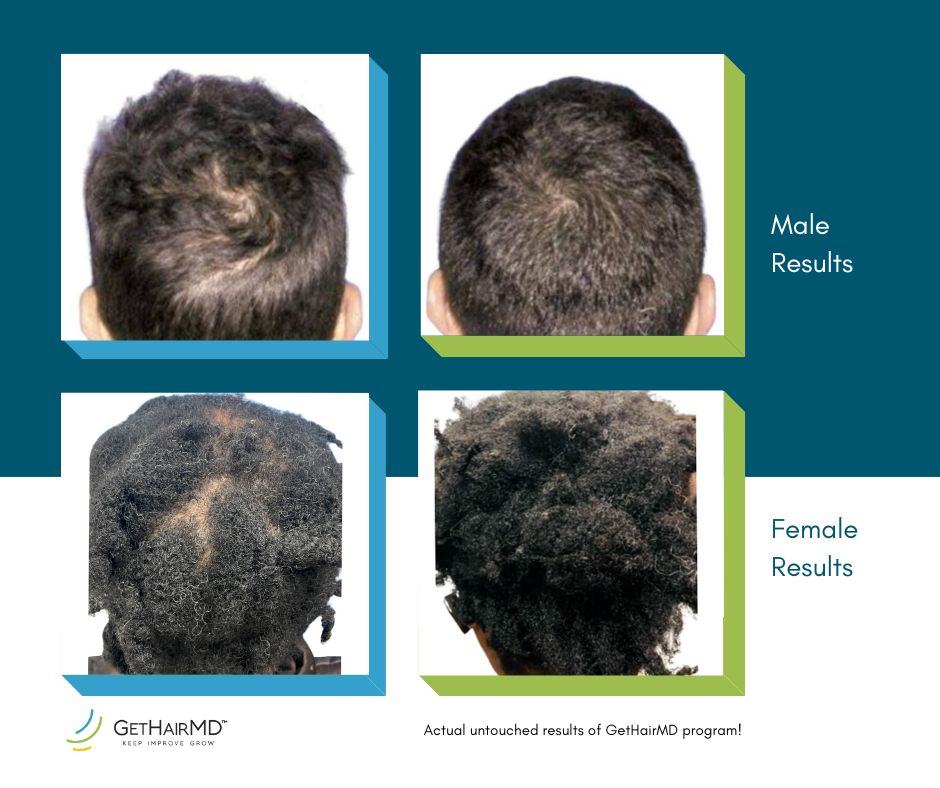 Before and after photos showing progress from hair loss treatment in Leawood for men and women with significantly more hair in the after photos