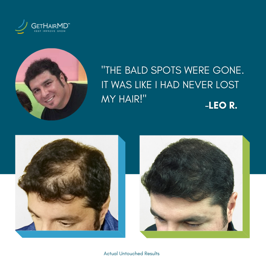 Quote above before and after photos that says 'The bald spots were gone. It was like I had never lost my hair!' from patient who completed a program for hair restoration near Overland Park