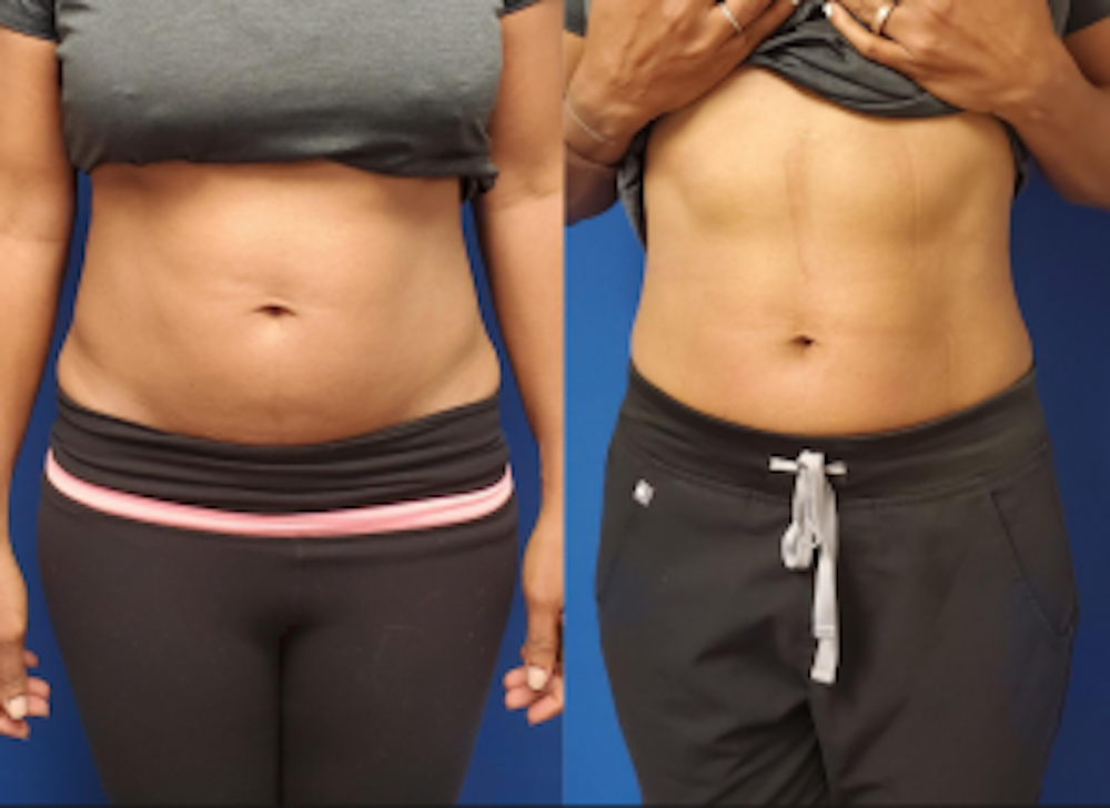 Before and after photos of woman who received body contouring on her stomach to pair with bioidentical hormone replacement therapy in Leawood